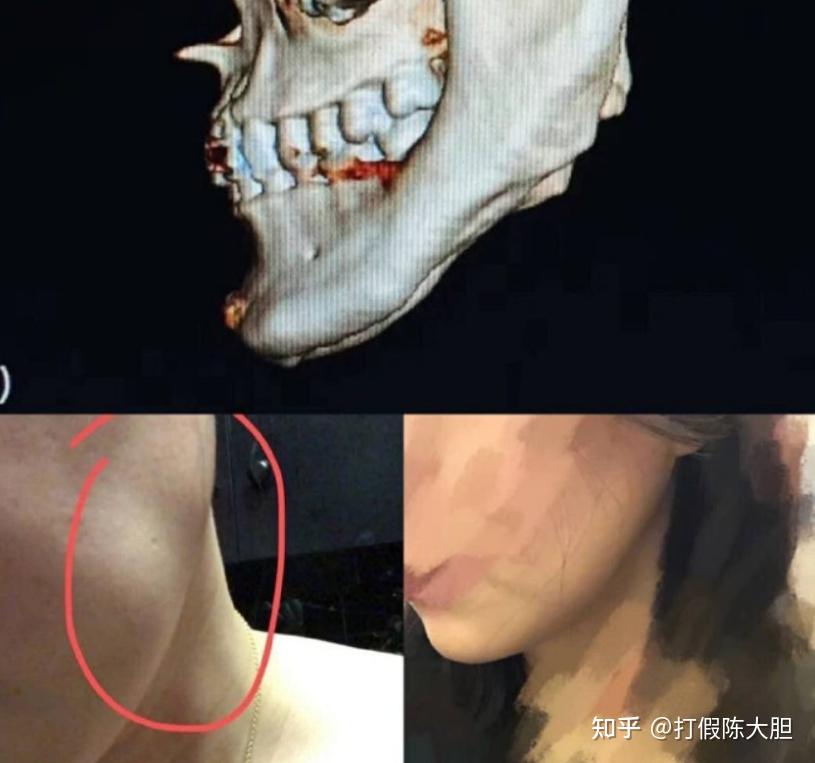 下颌角手术失败了想要去上海做下颌角修复手术有没有推荐哪位医生更加