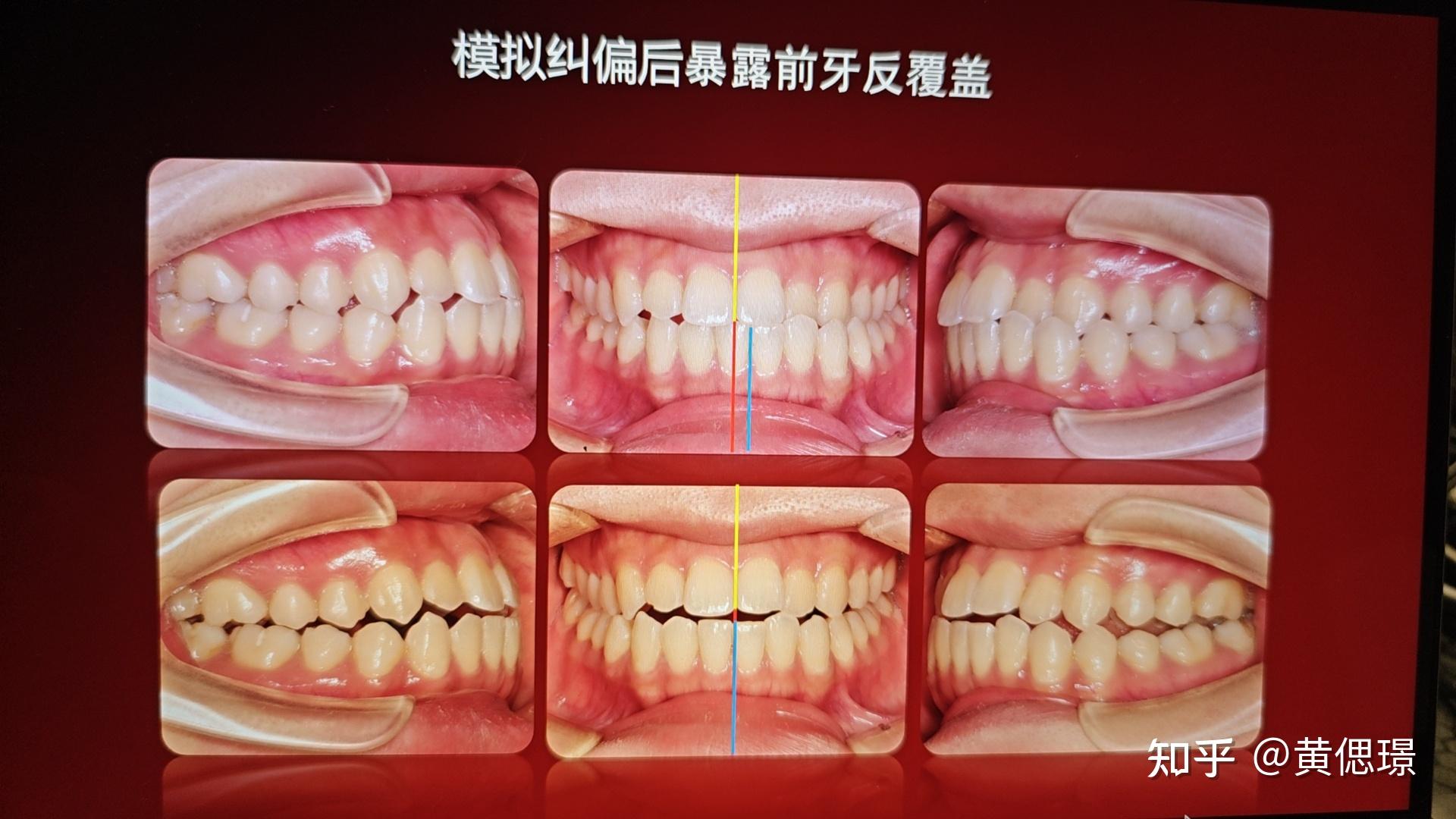 正畸诊断沈刚分类之偏颌 - 知乎
