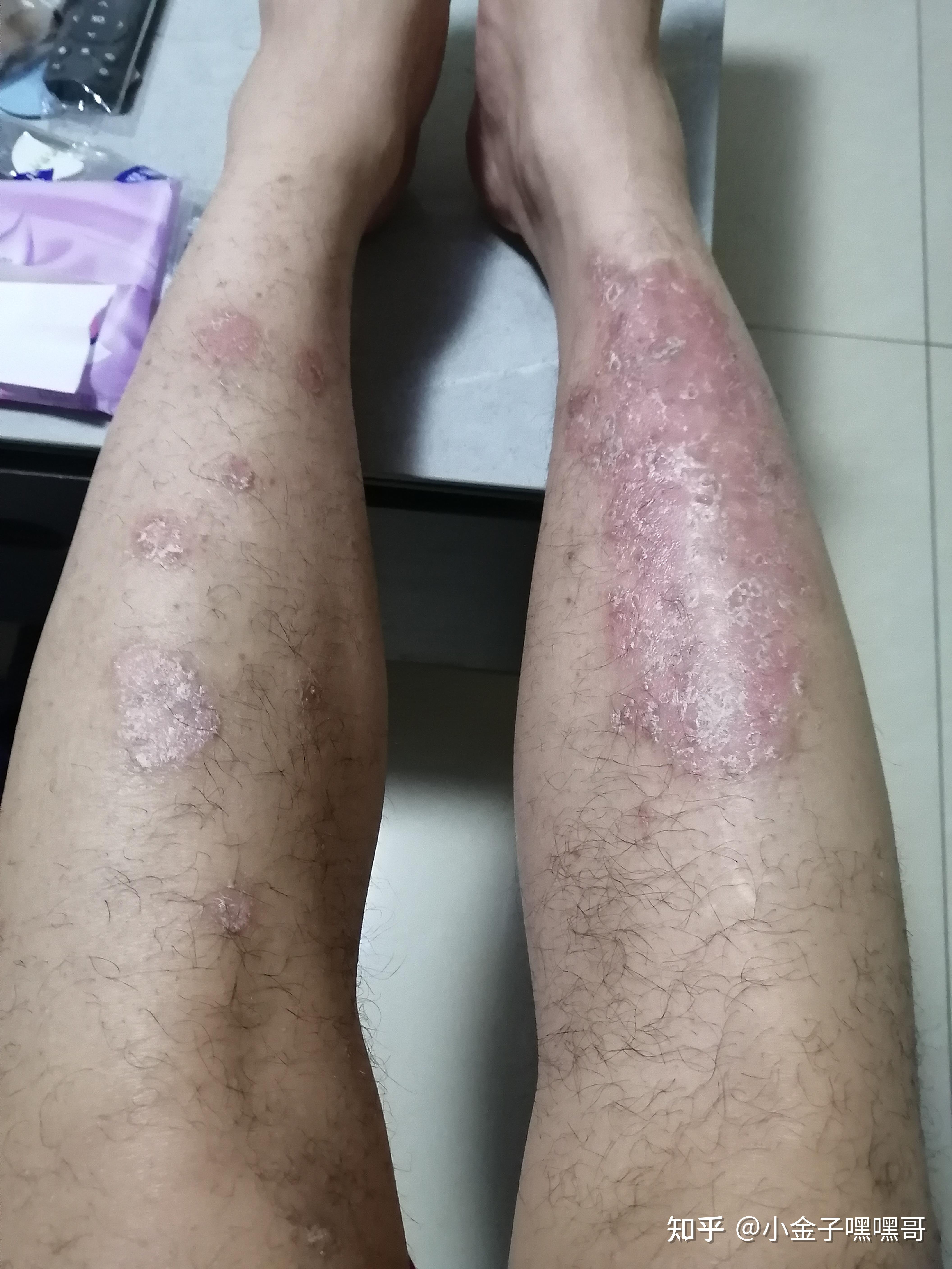 真实记录使用可善挺的效果