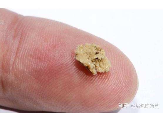 哈尔滨膀胱结石的主要临床表现-盘点女性膀胱结石的五大凶手 - 知乎