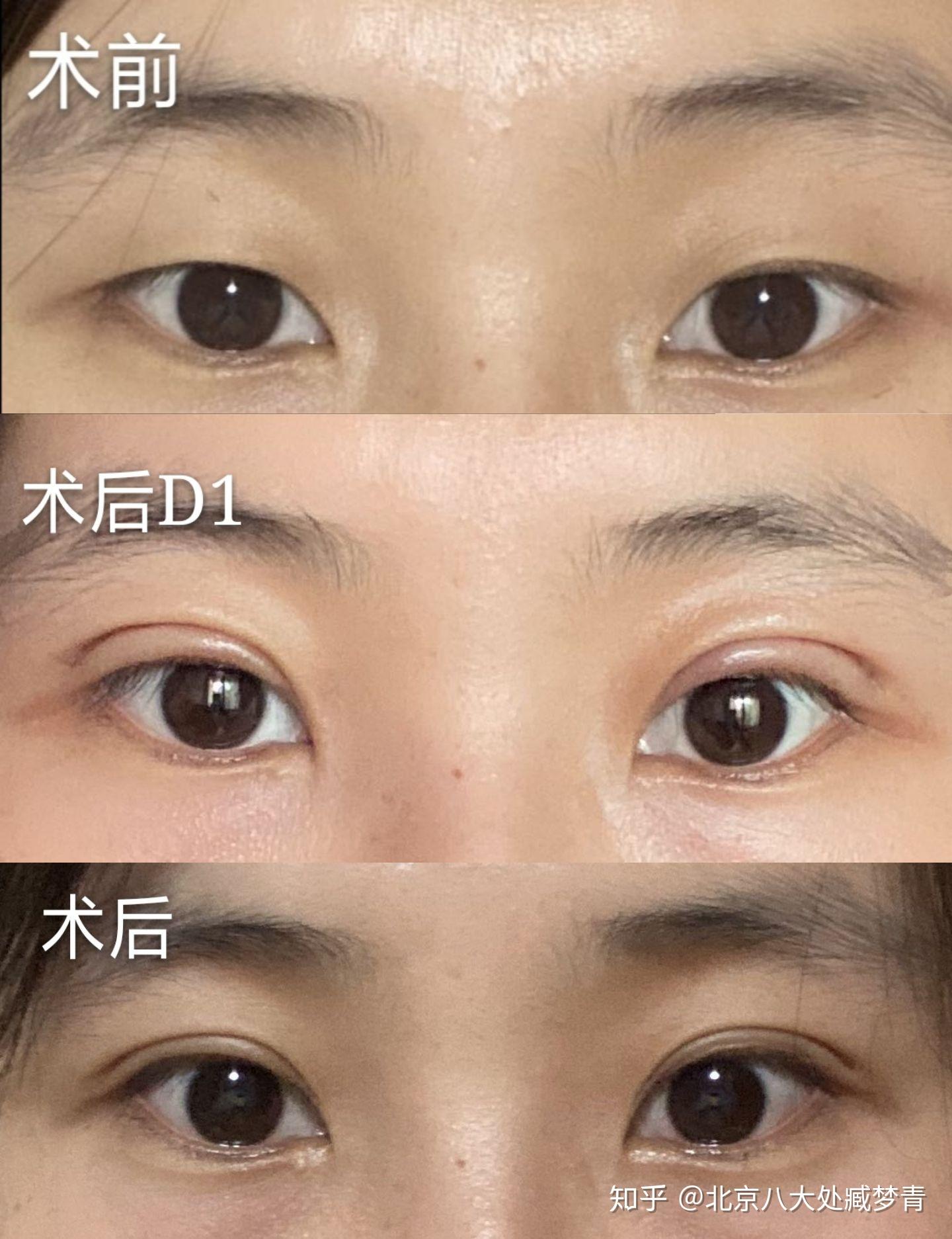 解析~最流行的五种双眼皮形态，哪一种适合你？ - 哔哩哔哩