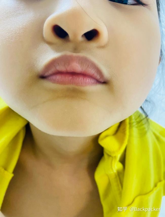 6岁宝宝传染性软疣的治愈过程