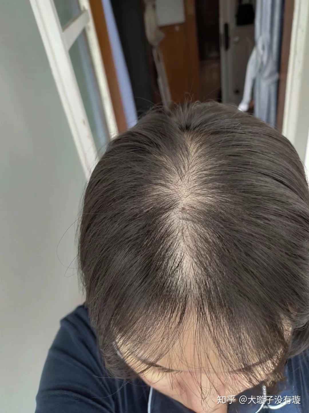 什么方法减少掉头发 v2-c51e4cd3e8a4fcd84fe3f46f8d4403a1_r.jpg