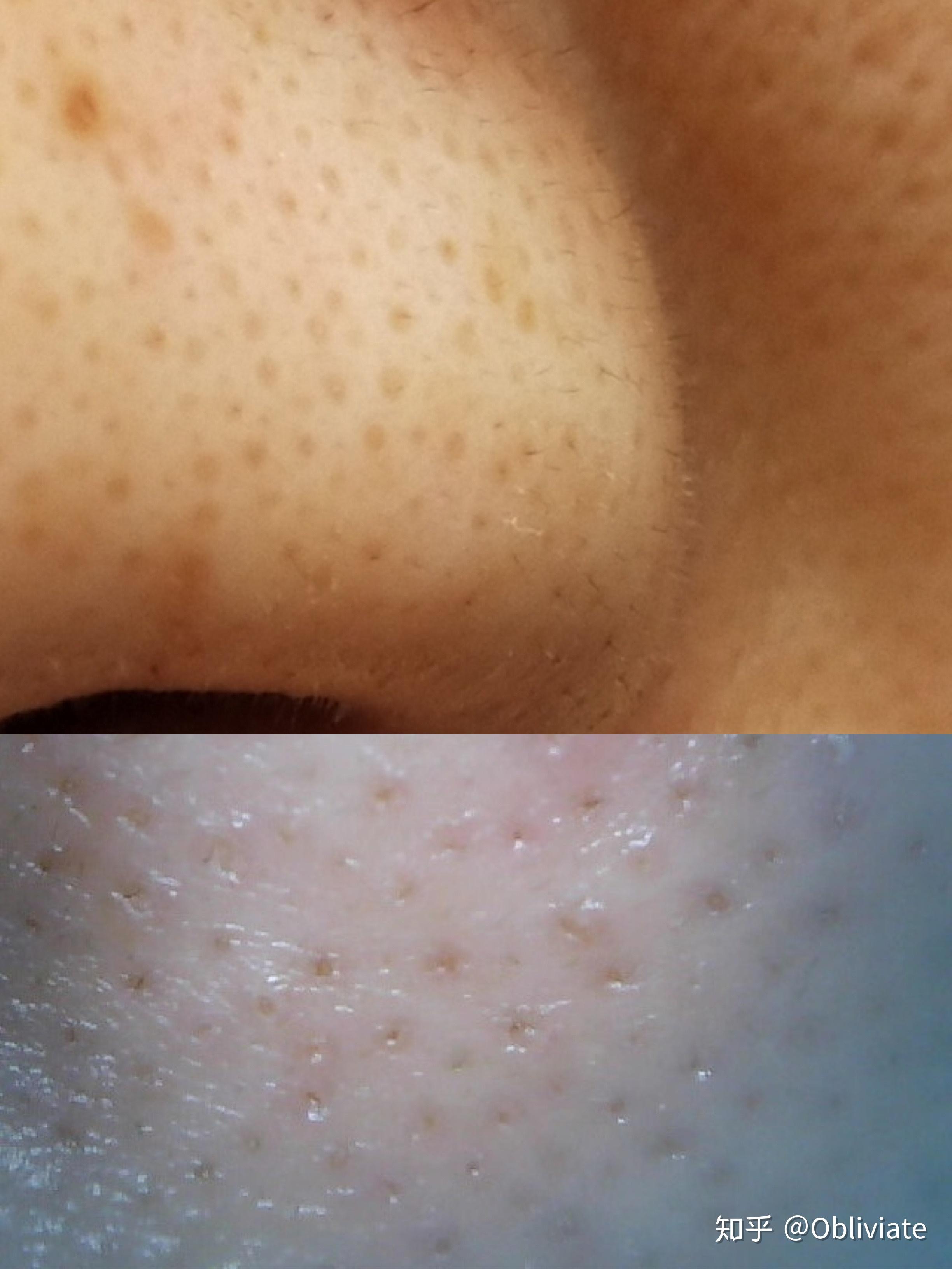 真相大白原来是假黑头难怪去不掉