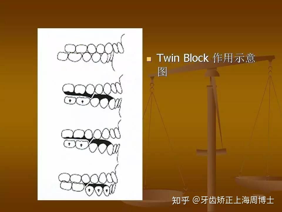 矫治原理:通过调整了的咬合斜面功能性的前移下颌来矫正上,下颌骨间的