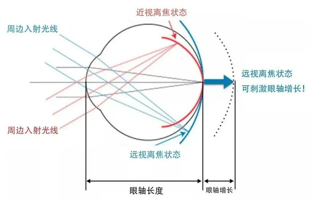 离焦眼镜是什么原理,真的可以阻止近视度数增长吗? - 知乎
