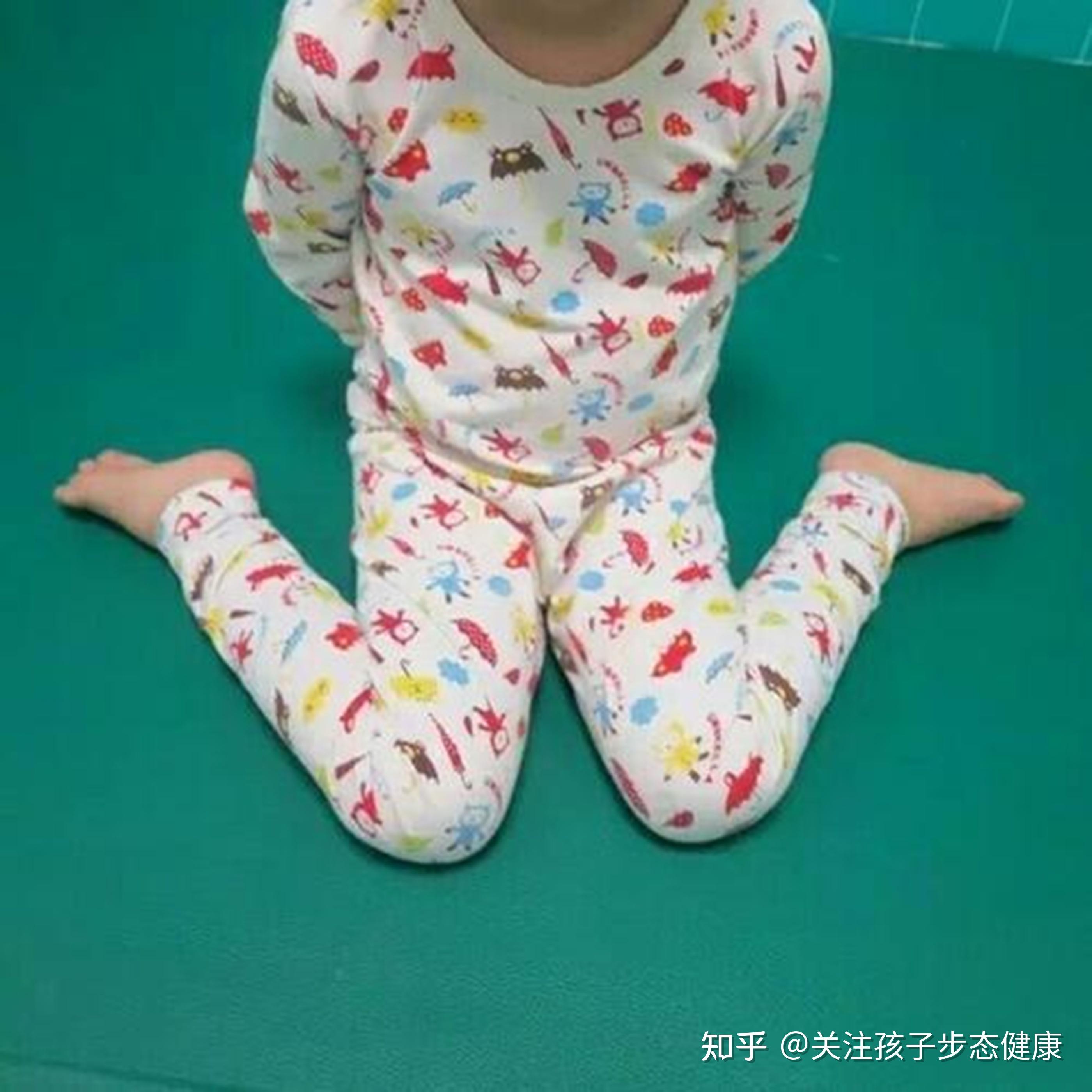 【宝宝腿型】3岁内宝宝的腿不是越直越好，罗圈腿才正常 -MamaClub – MamaClub