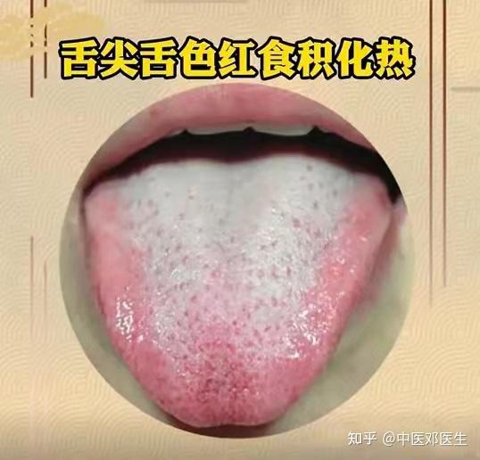 脾气虚舌象:舌淡白,齿痕明显,舌面偏湿脾虚痰湿重:舌质暗红或淡白,苔