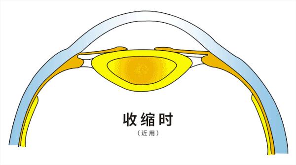 這是起點,當發生外界刺激時,睫狀肌開始收縮,收縮的過程才是調節