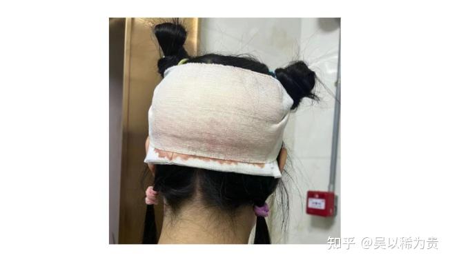 植发后去医院检查(植发检查费用是多少)