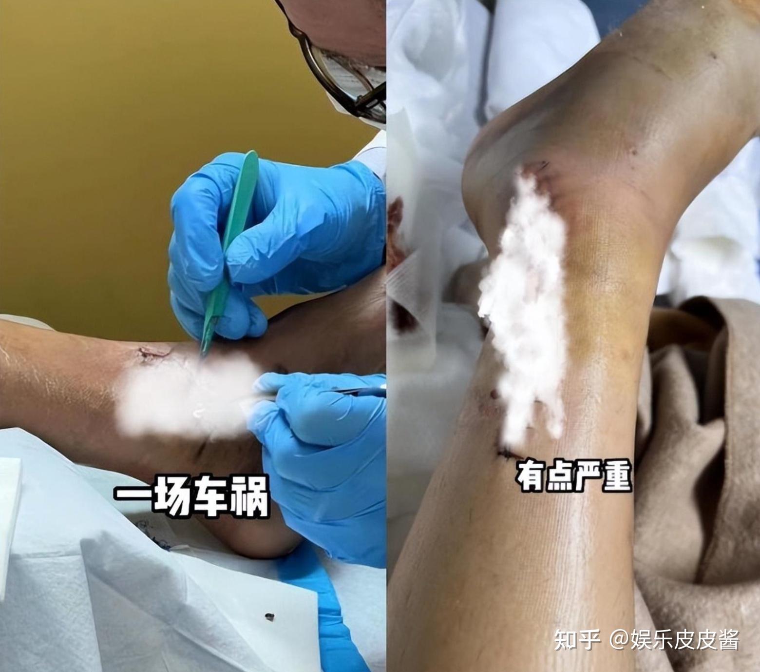 陈学冬出车祸伤到腿