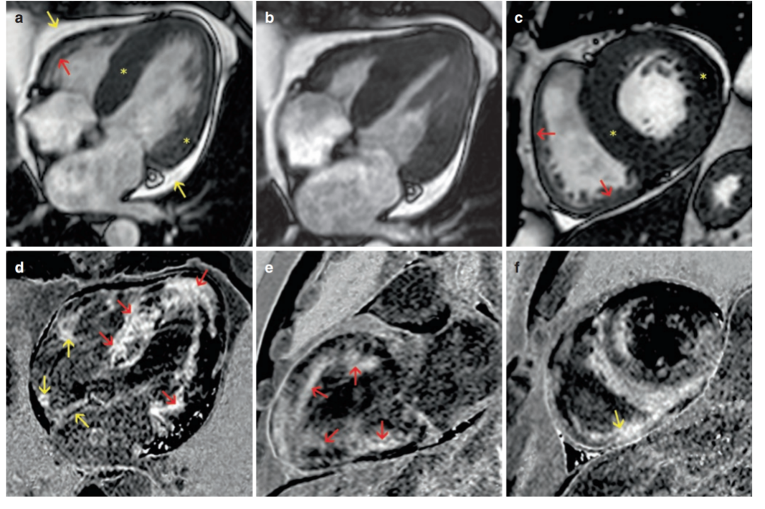 心脏磁共振典型病例集锦 - 知乎