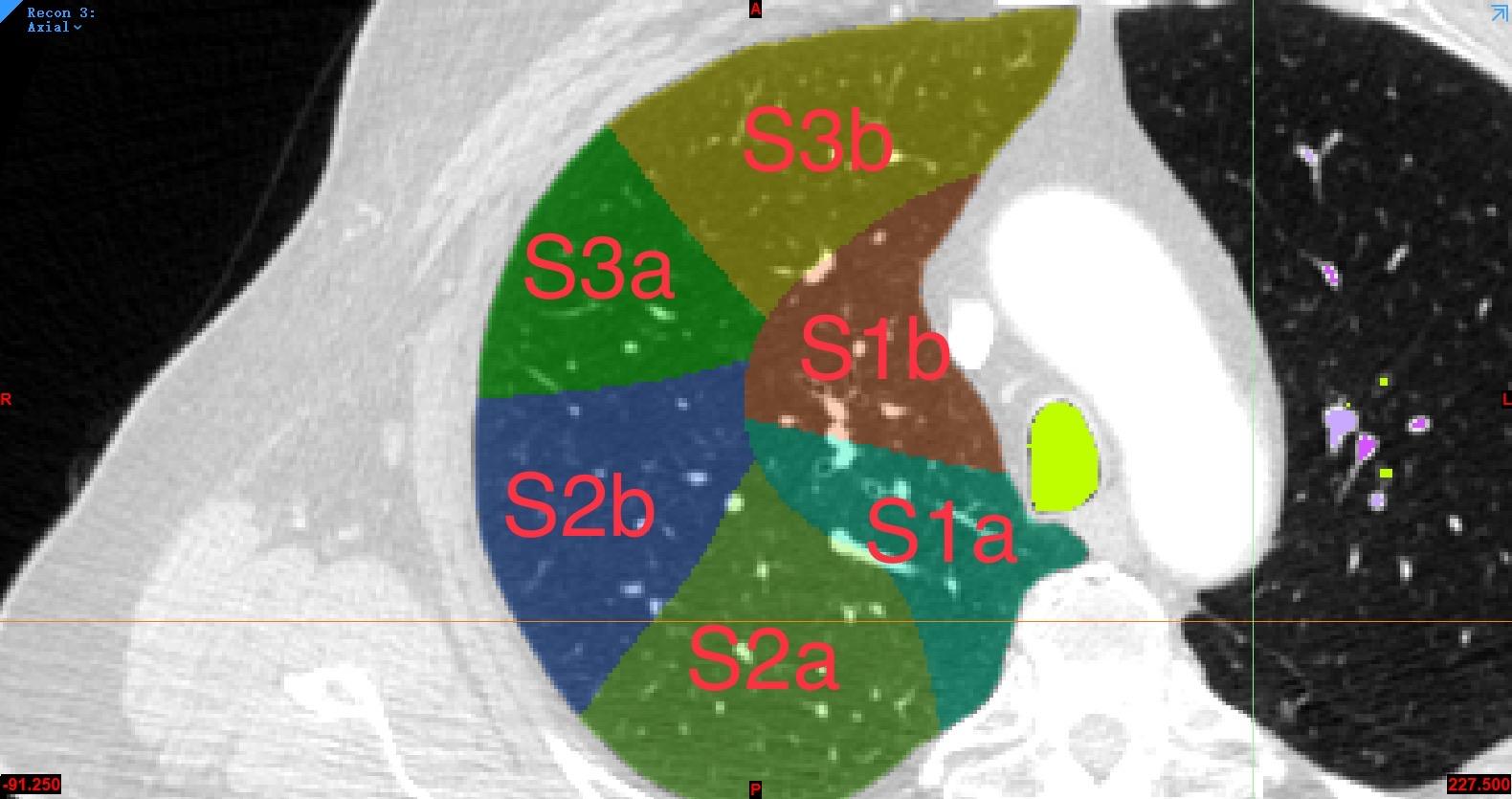 18段ct定位怎么看?