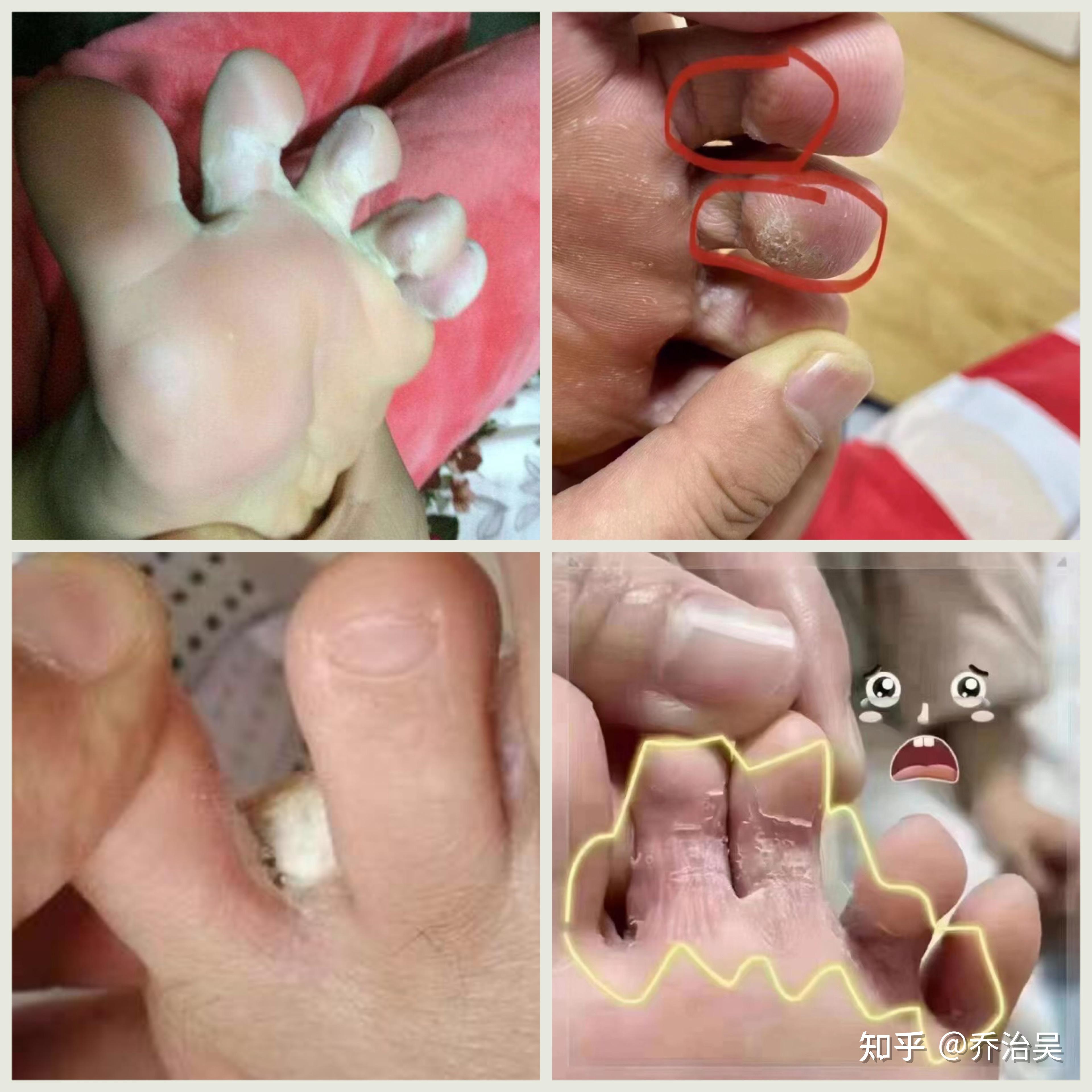 脚缝隙很痒怎么办