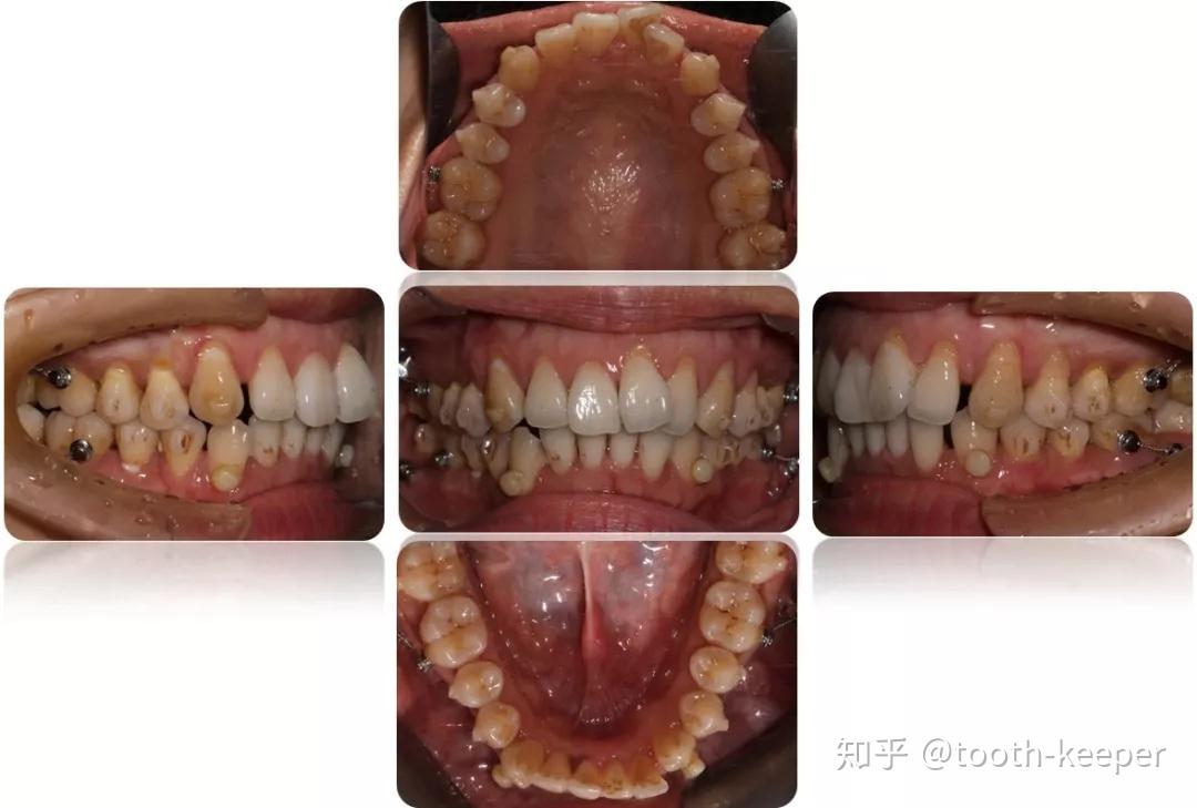 上下推磨牙远移解除拥挤改善前凸一例