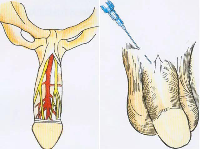 传统麻醉方法,大部分医院采用阴茎背神经阻滞麻醉,就是用注射器向阴茎