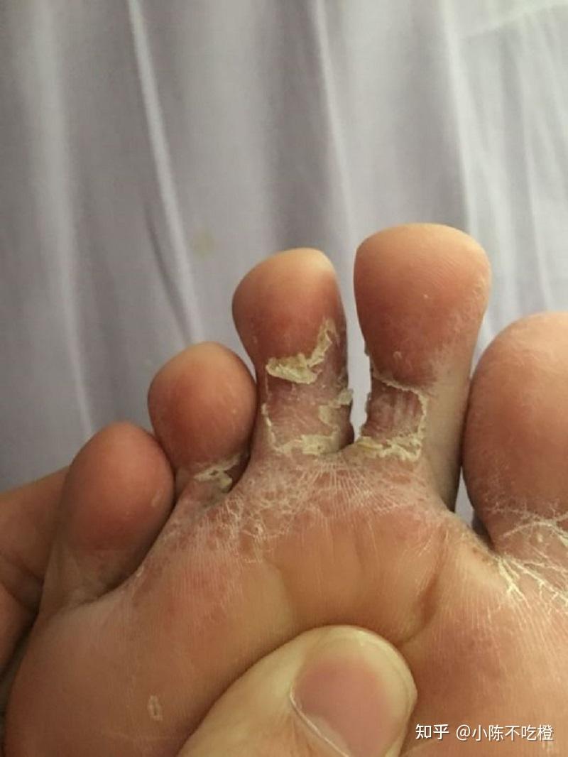 脚气水泡怎么办水泡型脚气水泡能不能扎破