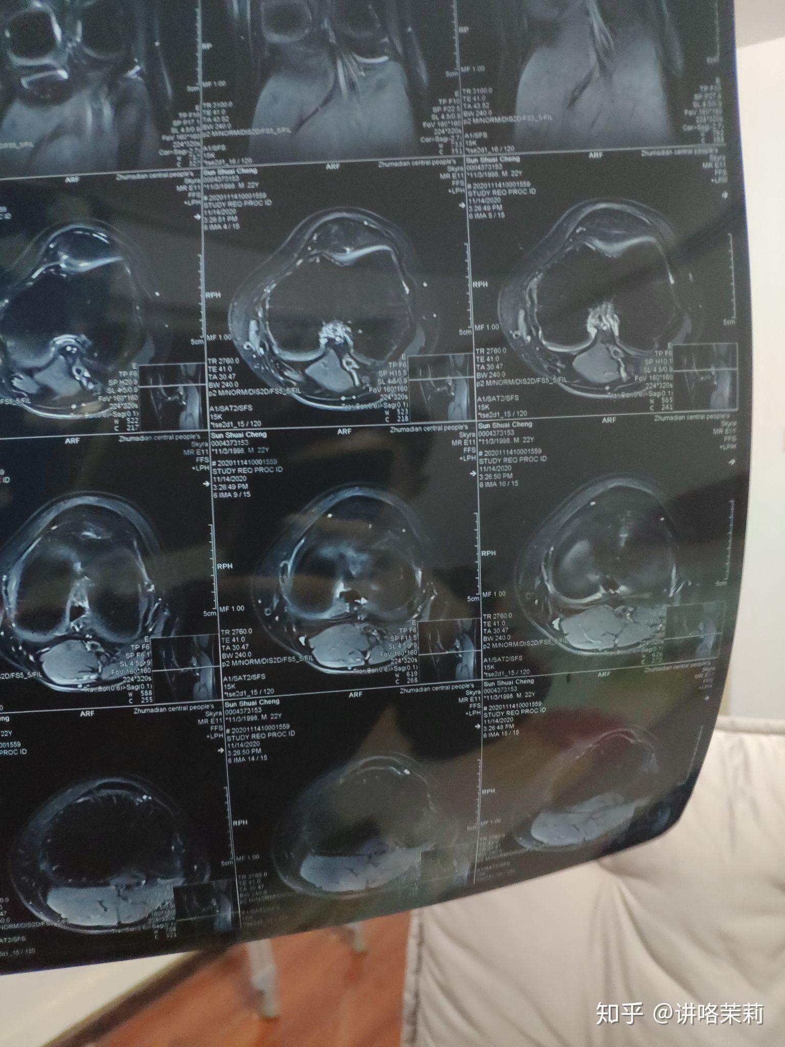 半月板后角变性怎么康复训练目前不能下蹲走路有点疼