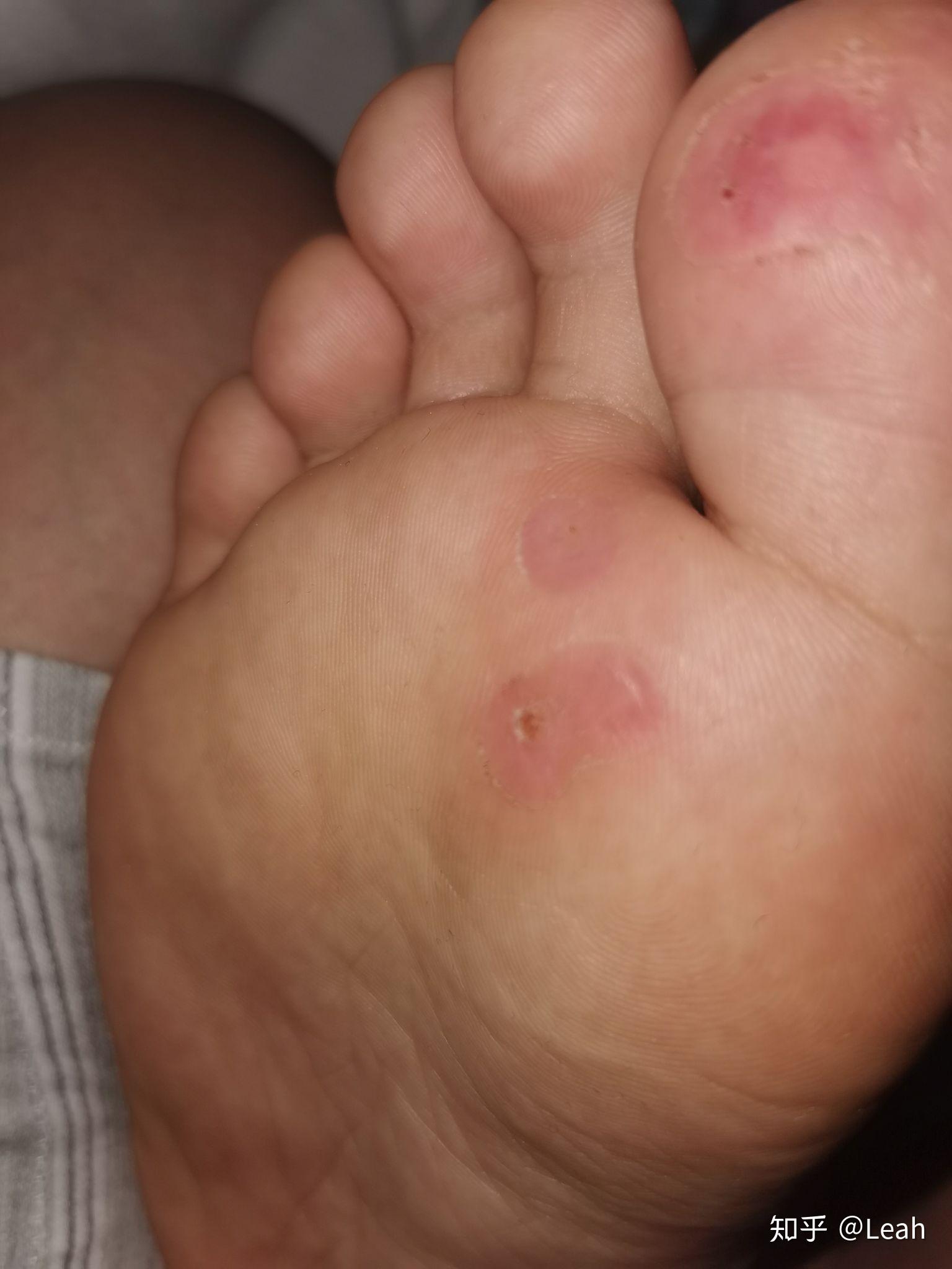 阿司匹林治跖疣有图慎入