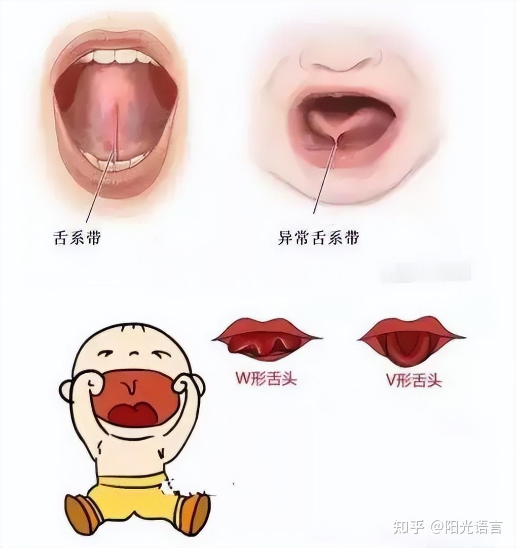 你不知道的舌系带分类标准,家长必看 - 知乎