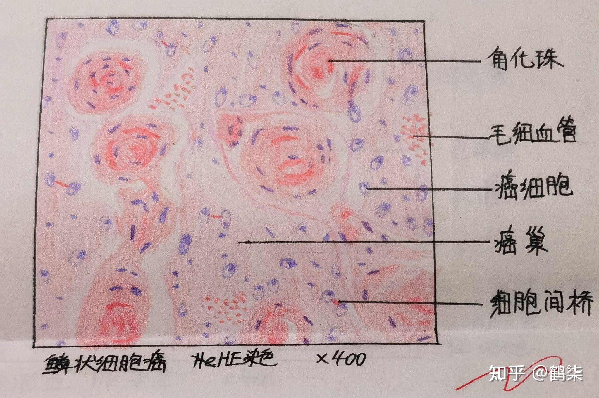 淋巴母细胞红蓝铅笔图片