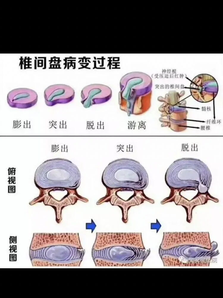 椎间盘突出示意图3D图片