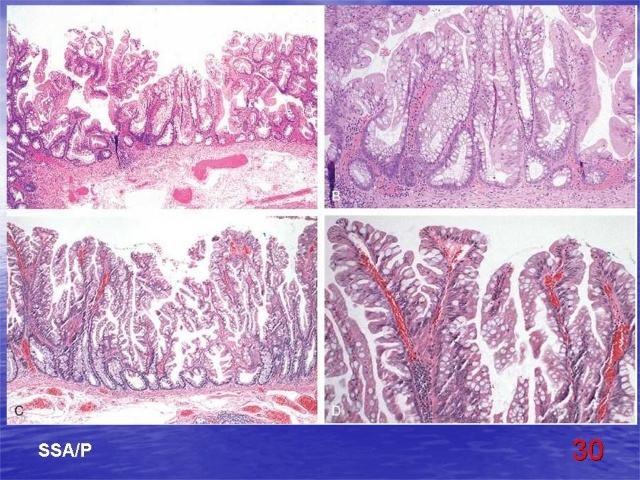 一文读懂结直肠癌病理报告