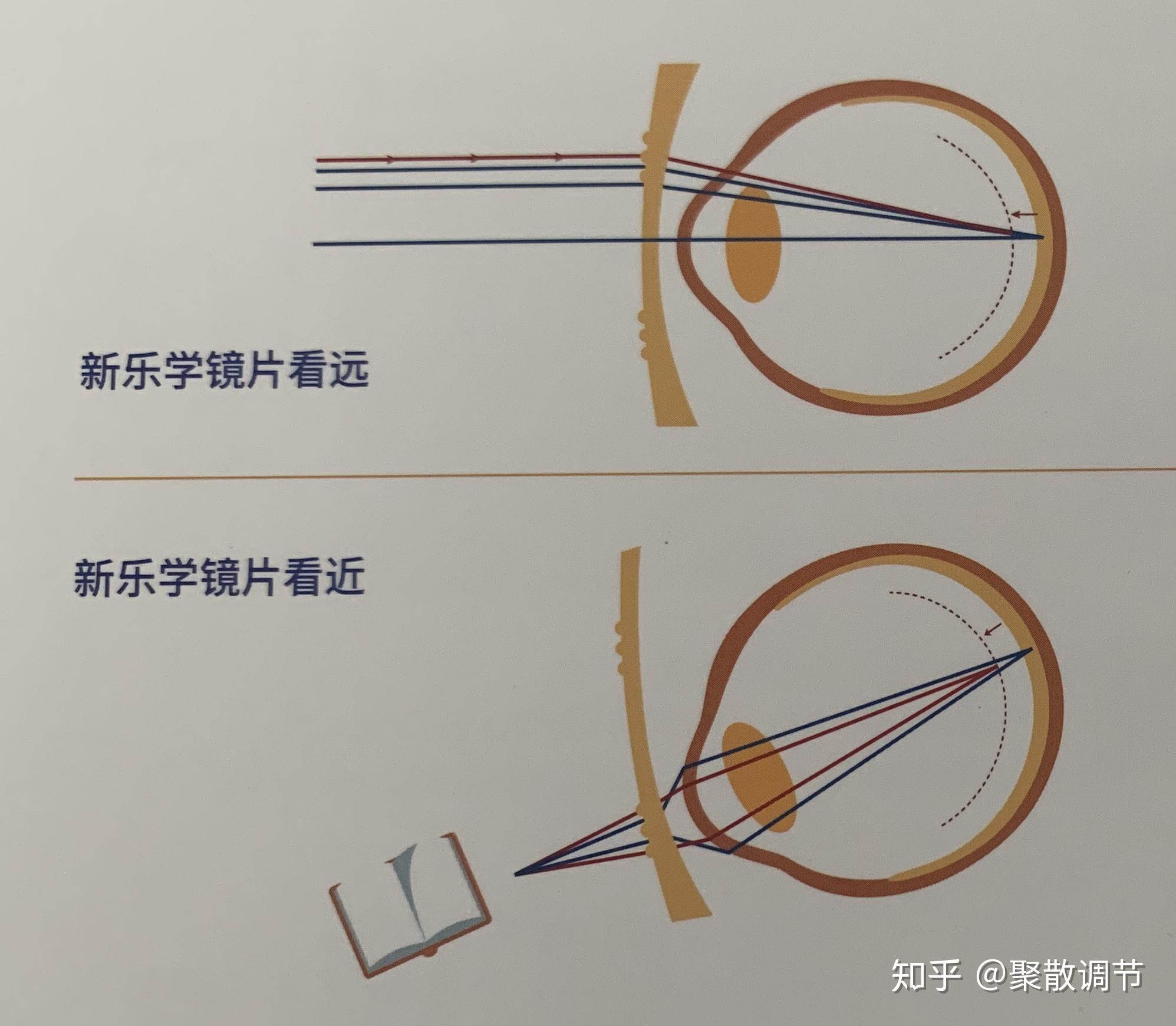 豪雅新乐学多点近视离焦—控制原理我之见