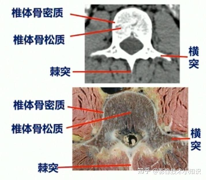 新手看胸椎ct片图解图片