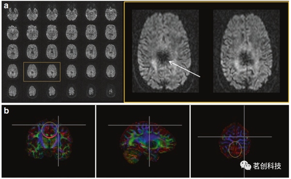 BOLD fMRI和DTI：伪影、技巧和诀窍 - 知乎