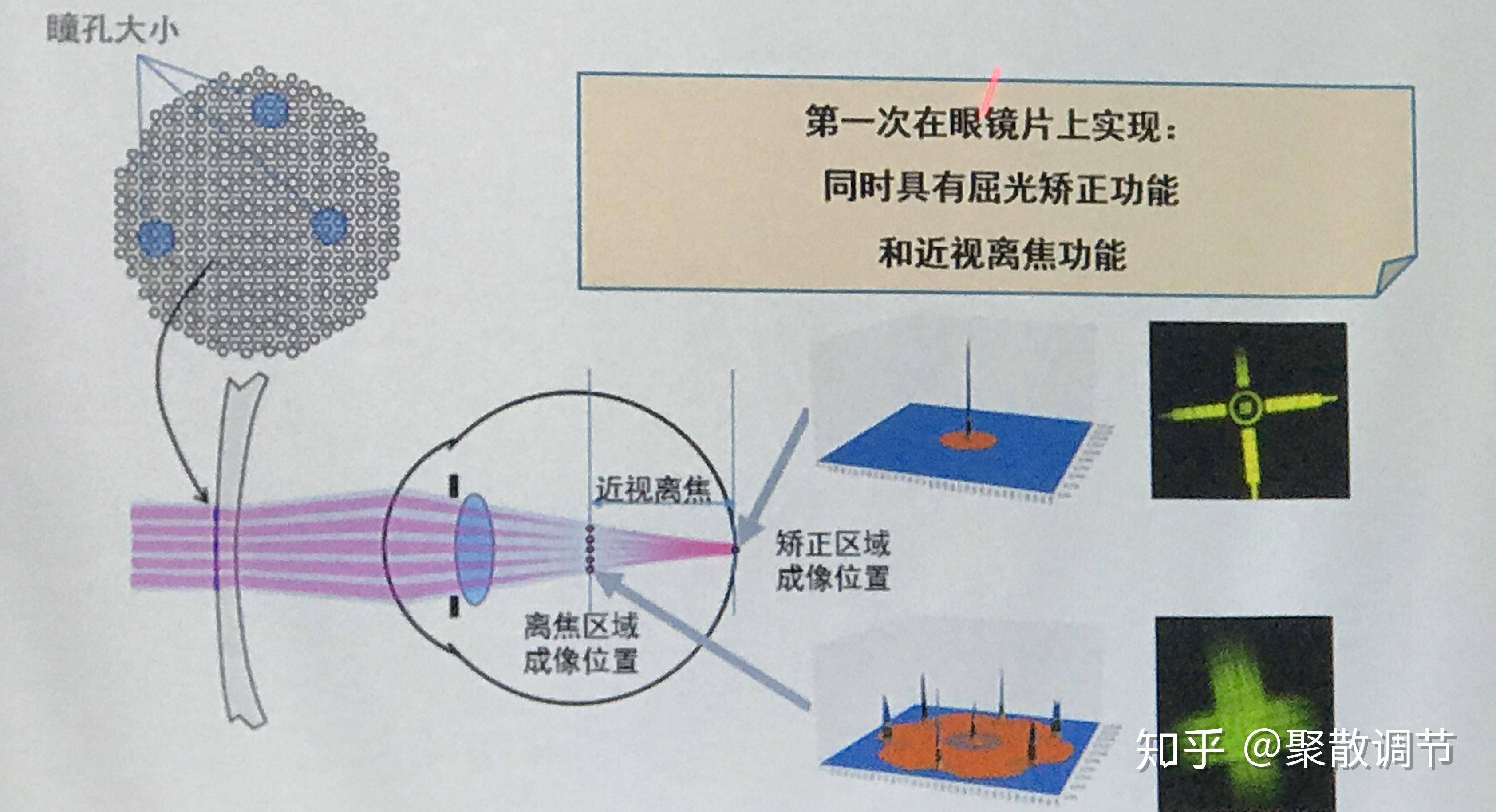 豪雅新樂學多點近視離焦—控制原理我之見 - 知乎