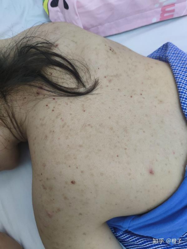 如何去背部痘印