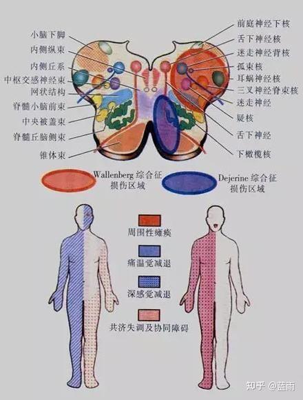 延髓背外侧综合征图片