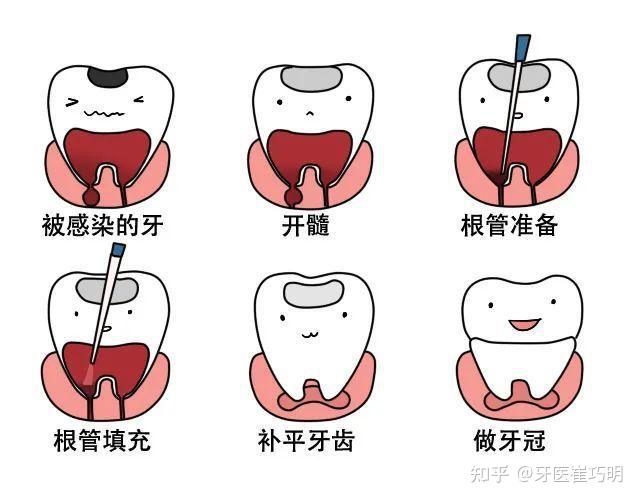 一文快速带你了解根管治疗 - 知乎