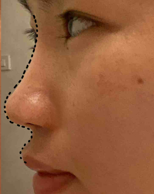 鼻子美不美决定权在山根还是鼻部曲线