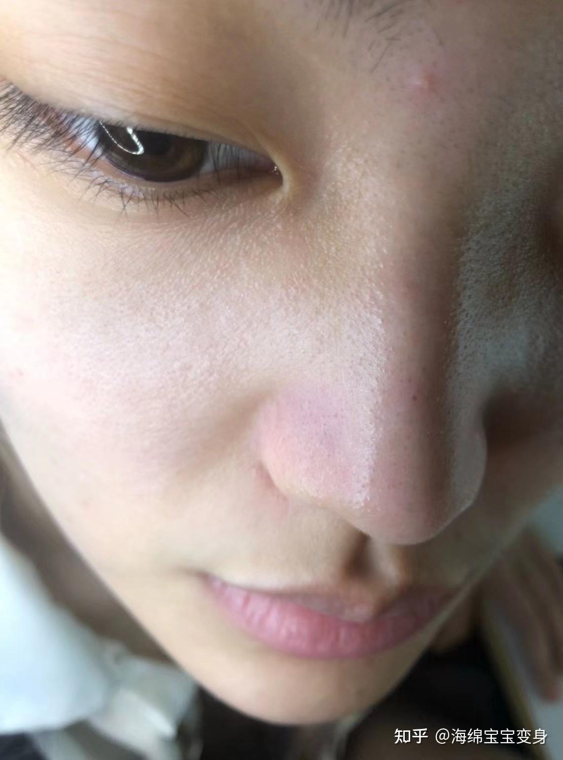 帮忙看看我这是毳毛还是黑头有什么治本的办法吗