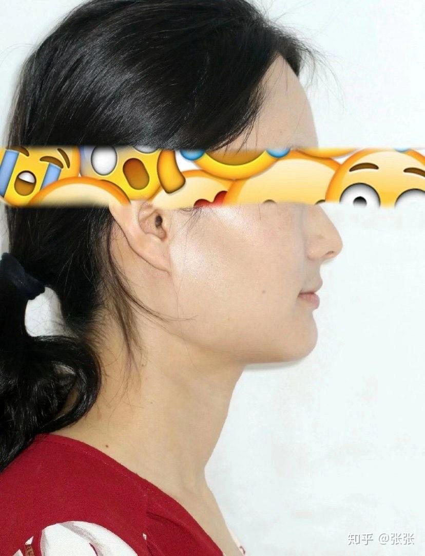 磨骨不是小手术医生都不会告诉你的磨骨后遗症