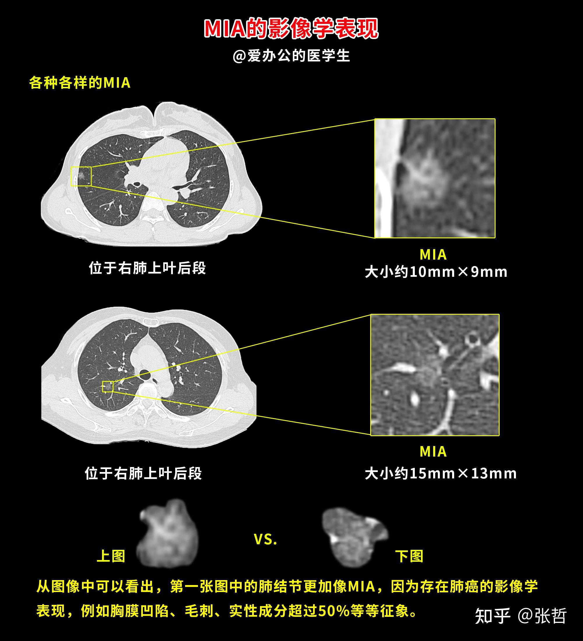 肺结节的影像学表现