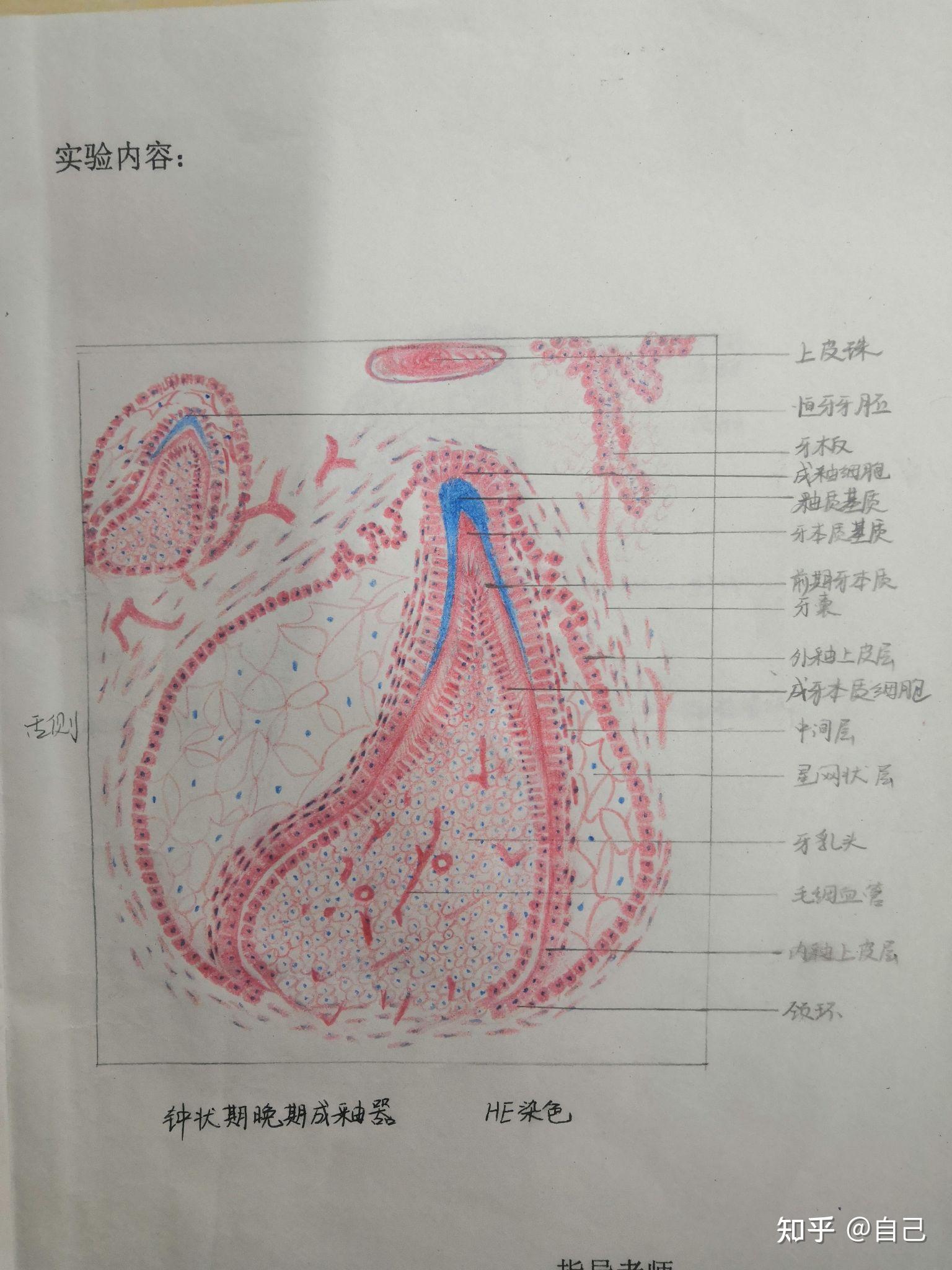 成釉细胞瘤手绘图片