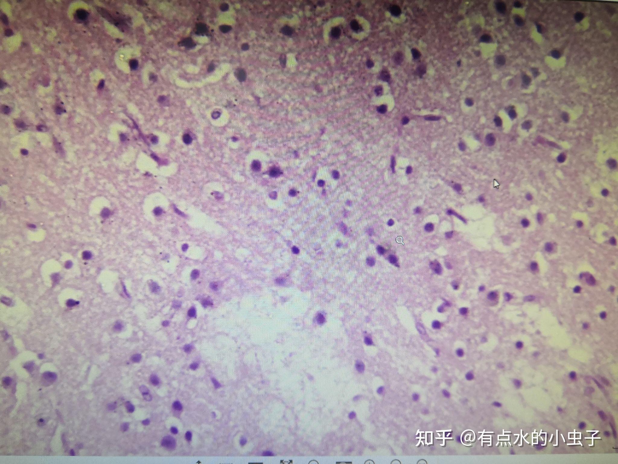 脾凝固性壞死(脾臟梗死)脾小動脈玻璃樣變肝脂肪變性子宮頸原位癌鱗狀