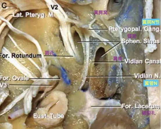 切除翼突,顯露翼管神經通過翼管,加入翼顎神經節和上頜神經.