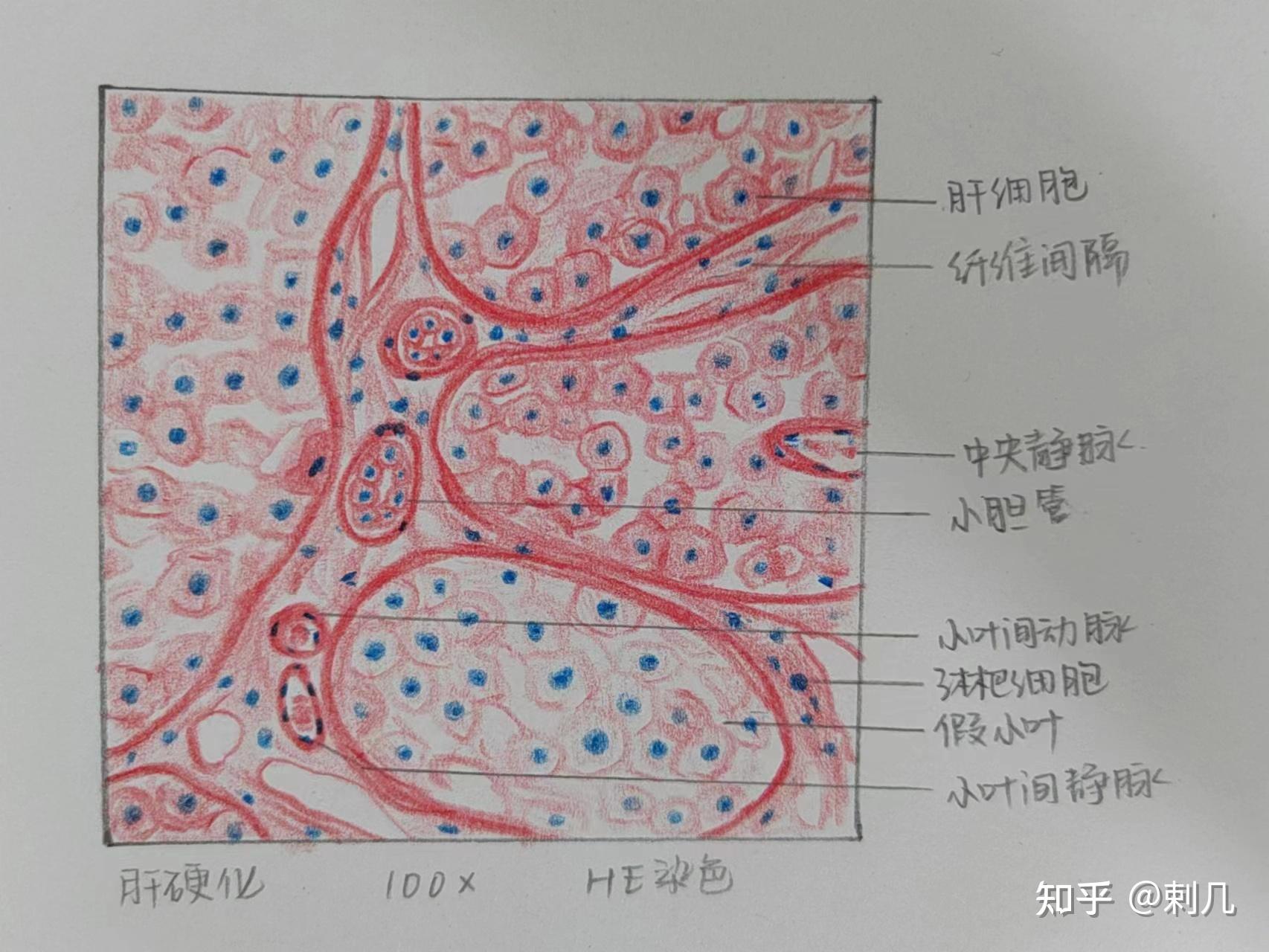 肝硬化