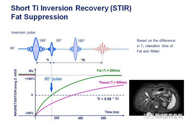 t1flair序列对不起这个表述不严谨