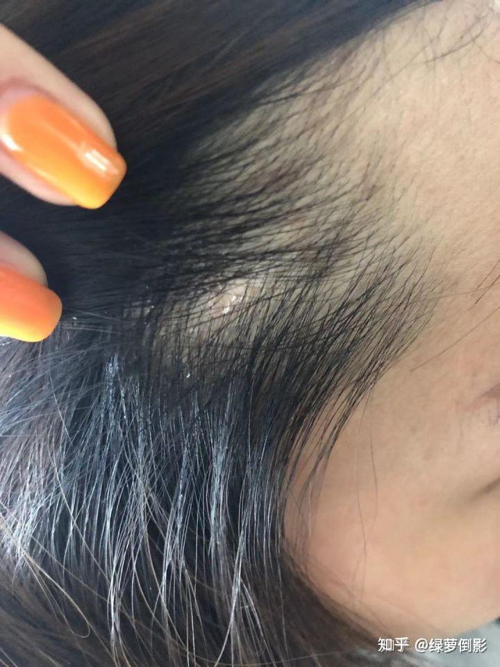 脱发掉发严重怎么办用什么药 v2-c77c4e582ded45fb36f97a150696b711_r.jpg