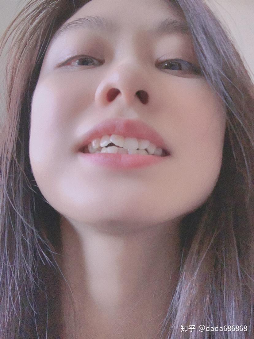 这一两年我发现下门牙跟着上门牙的飘,人的牙齿确实一直在移动