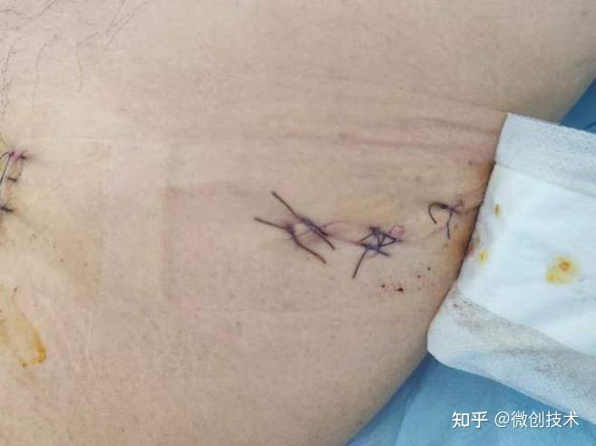 案例解析|西南医科大学附属医院c3型骨盆骨折微创手术