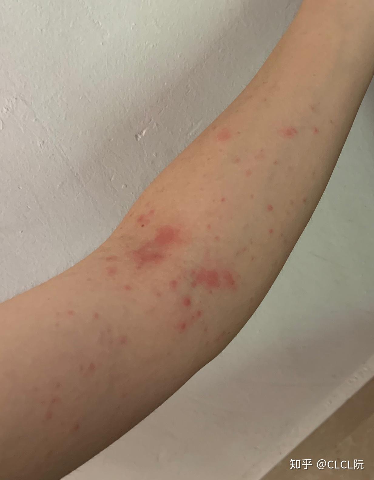 到山里吃了顿农家菜就傻掉了,,,昆虫性过敏 - 知乎