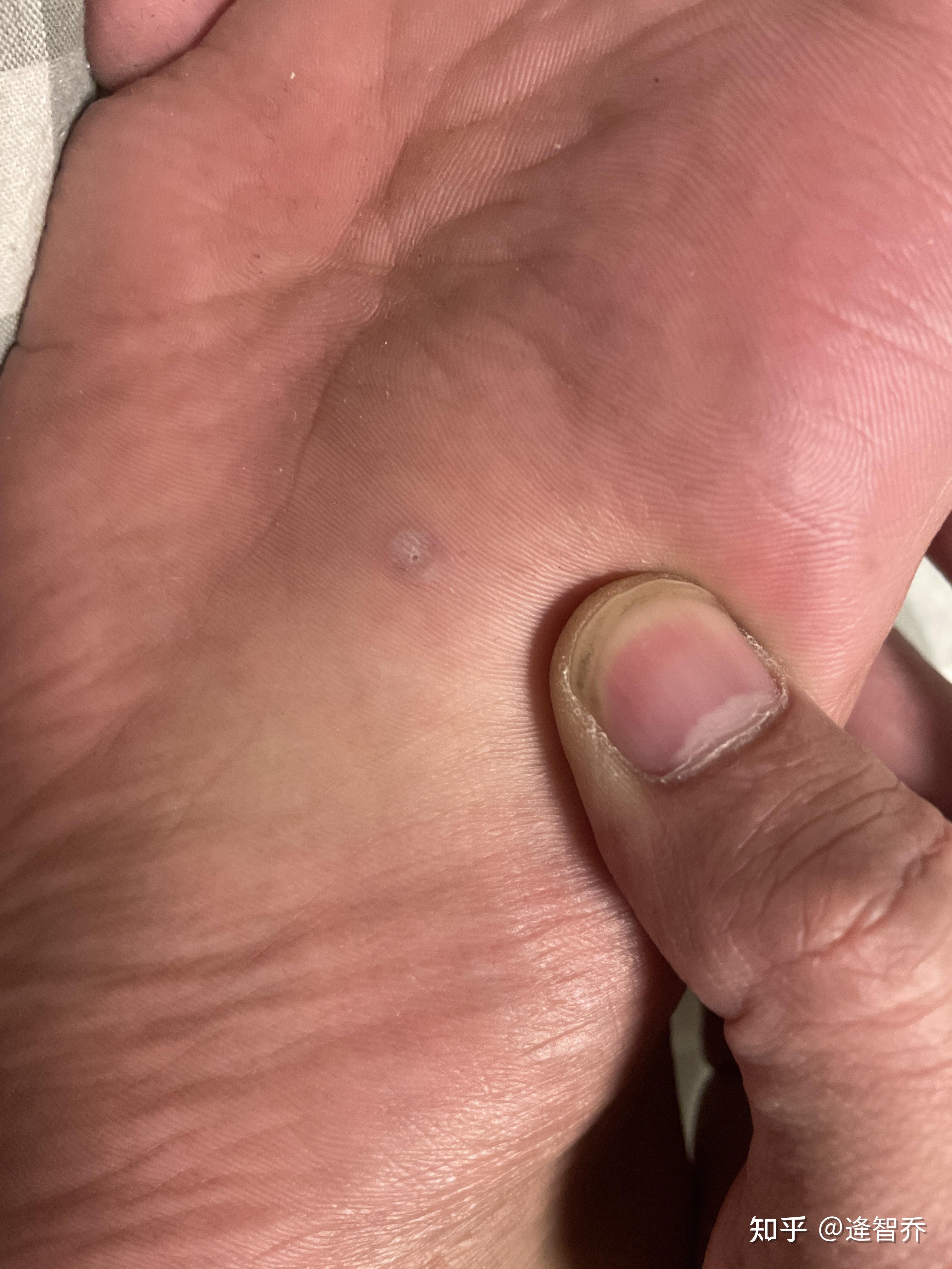 右脚这里有一个这样的,不知道是什么,之前左脚的那个是褐色的一个丘疹