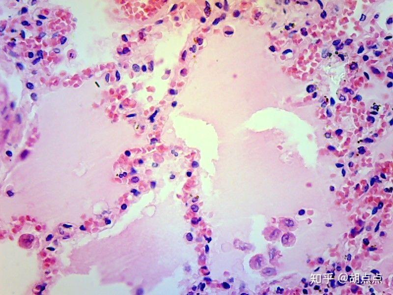 慢性肺瘀血,蜂窝织性阑尾炎,肺脓肿,鳞状上皮细胞乳头状瘤电镜下高低