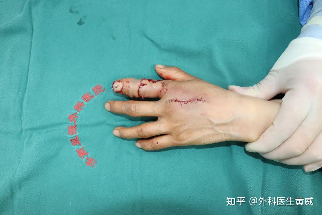 皮筋缠绕导致手指缺血性坏死,手指再造专家如何让手指复原! 